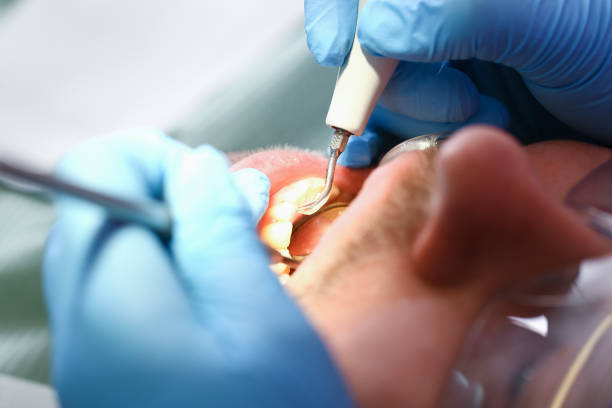 Best Knocked-Out Tooth (Avulsed Tooth) Treatment in Martinsburg, WV
